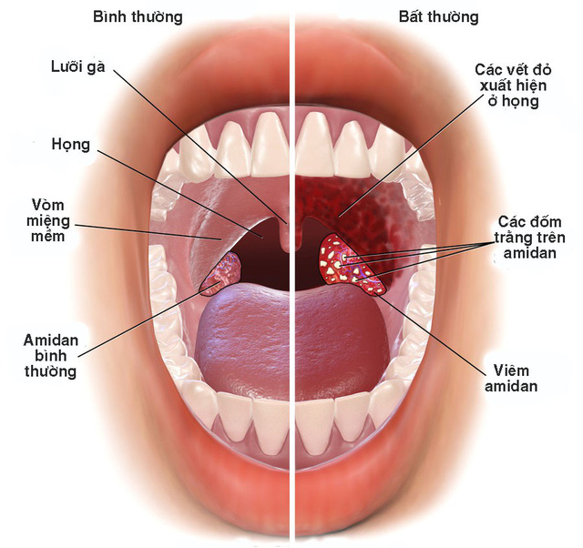 Viêm họng là tình trạng viêm tại niêm mạc ở họng