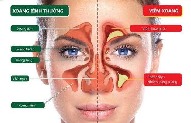 Bệnh viêm xoang xảy ra khi có sự xâm nhập của vi khuẩn